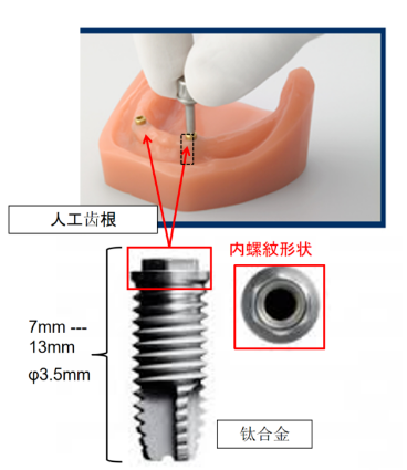 種植牙內螺紋銑削.png